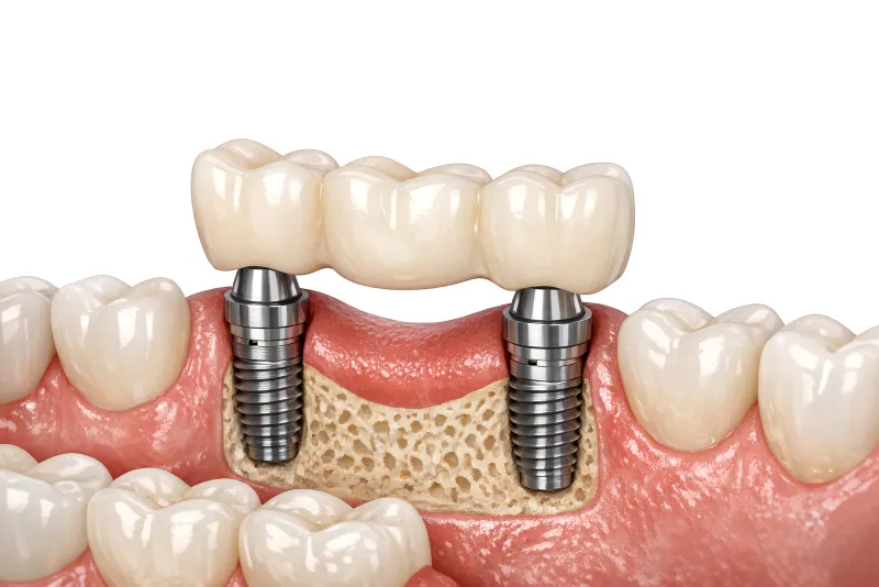 Dental bone grafting procedure illustration
